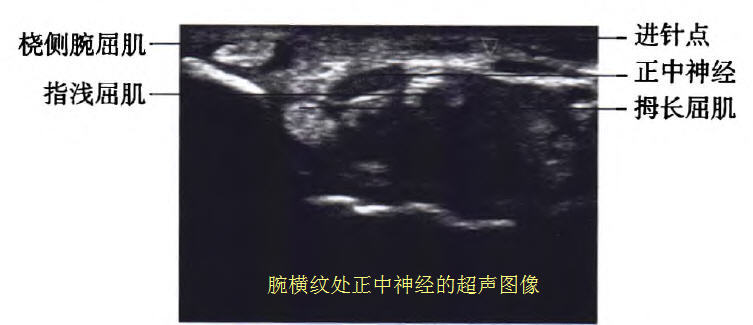 腕管综合征超声介入治疗,超声引导下腕管综合征注射治疗