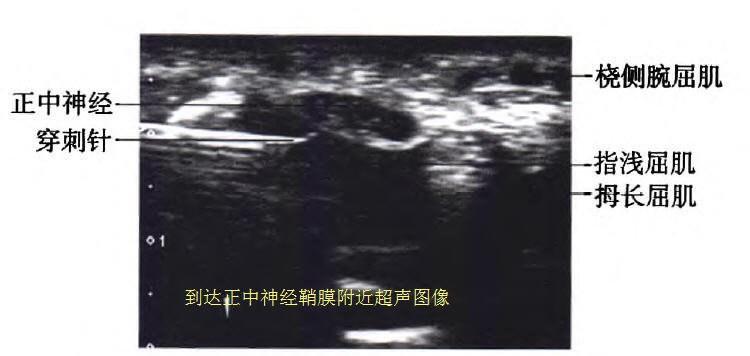 腕管综合征超声介入治疗,超声引导下腕管综合征注射治疗
