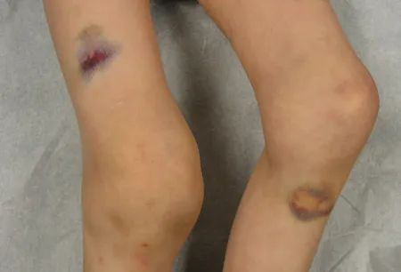 血友病同急性髓系白血病的区分,得了血友病还能得白血病吗