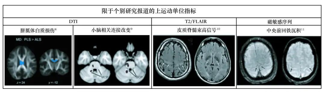 下肢运动神经元综合征可以治疗吗,怎么诊断得了运动神经元病