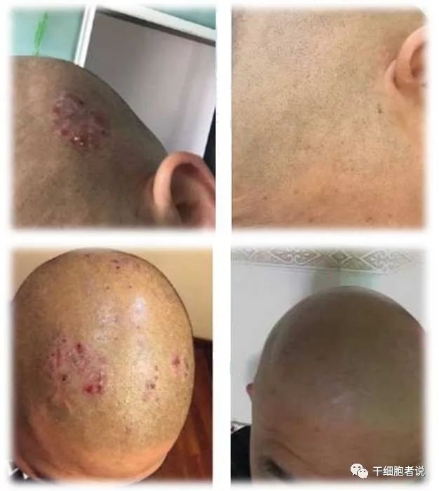 间充质干细胞银屑病复发,间充质干细胞和神经干细胞区别