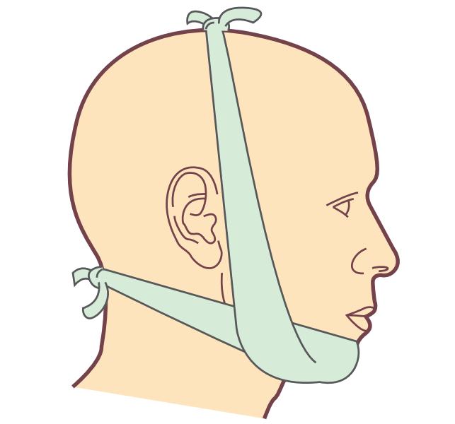 哪几处骨折最轻,头部骨折分为几种类型