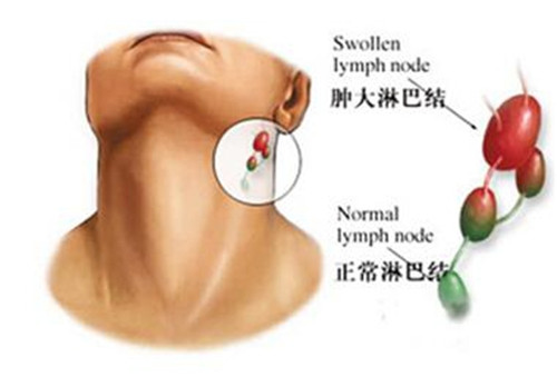 皮下起包有痛感切了又长起来,微创伤口皮下小硬结