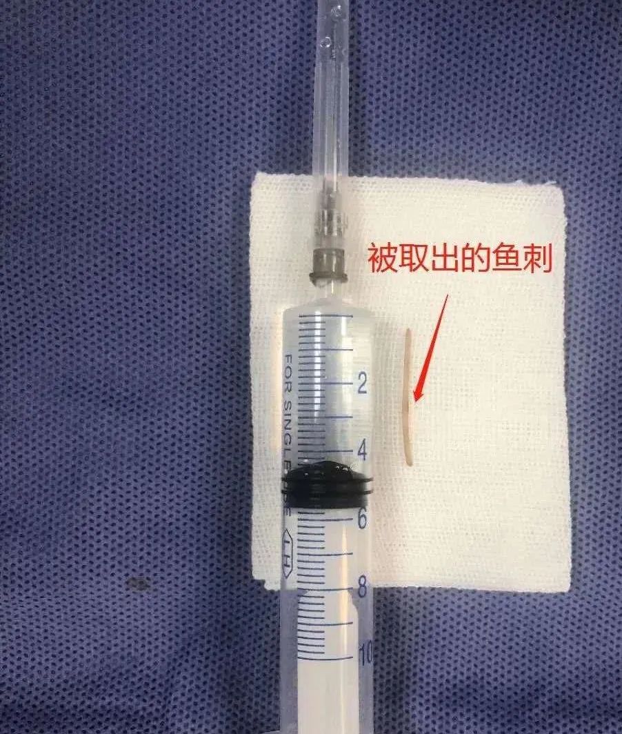 女士长了痔疮,女子得痔疮痛不欲生