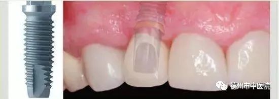德州哪个医院种植牙比较好,德州齐河口腔医院种牙