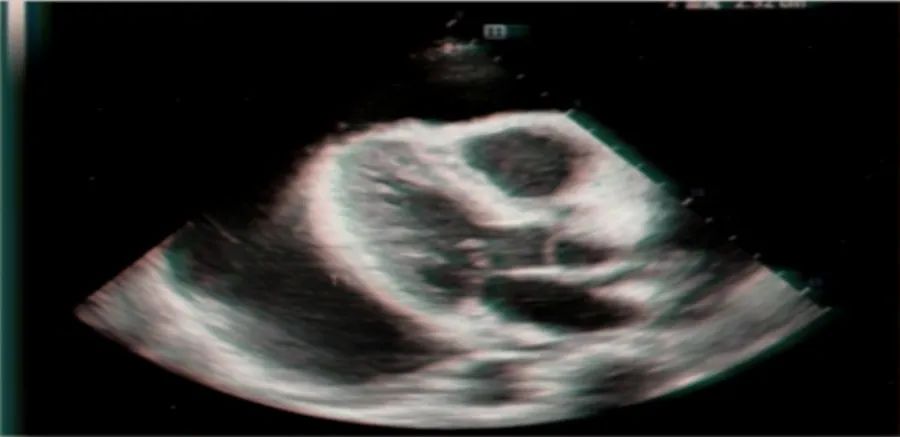 恶性心包积液怎么引起的呀,不明原因反复大量心包积液怎么办