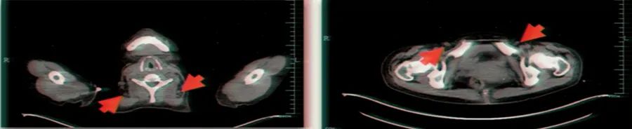 恶性心包积液怎么引起的呀,不明原因反复大量心包积液怎么办