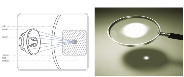 超声聚焦消融治疗肿瘤视频,高强度聚焦超声热消融肿瘤治疗