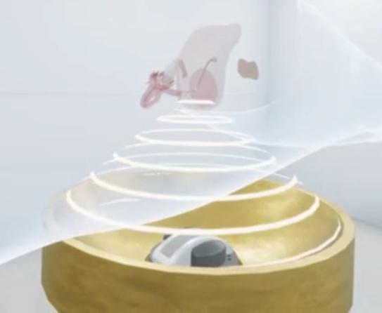 超声聚焦消融治疗肿瘤视频,高强度聚焦超声热消融肿瘤治疗