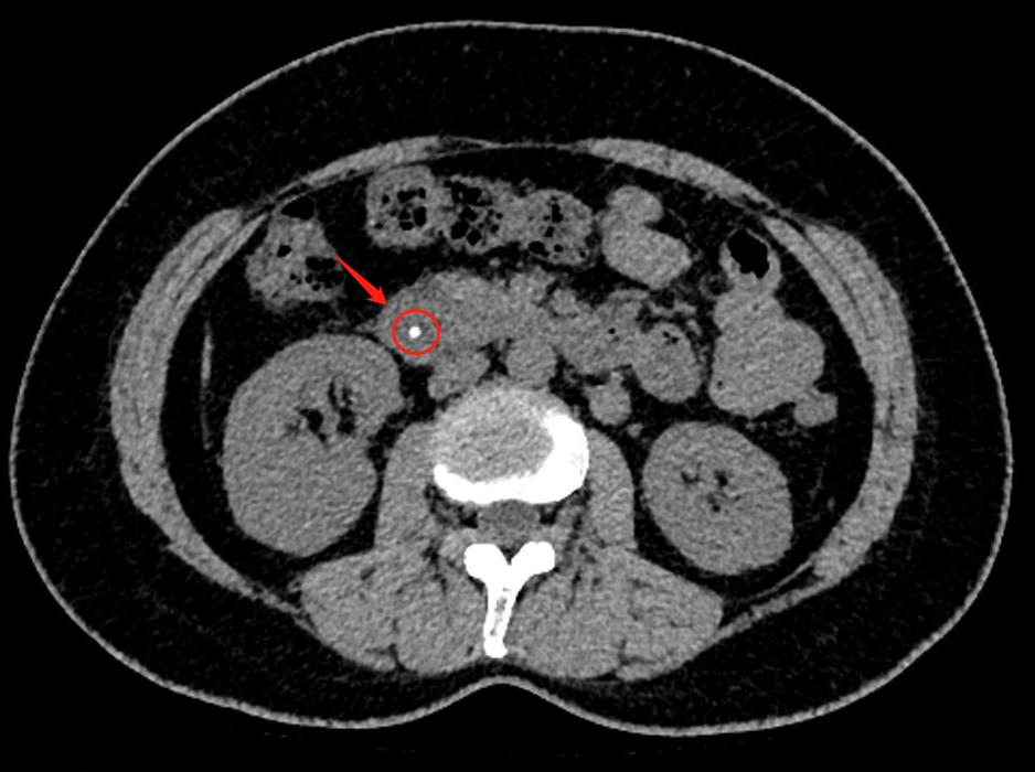 男子体内排出活虫只因爱吃一道菜,女子体内活虫蠕动只因爱吃这道菜