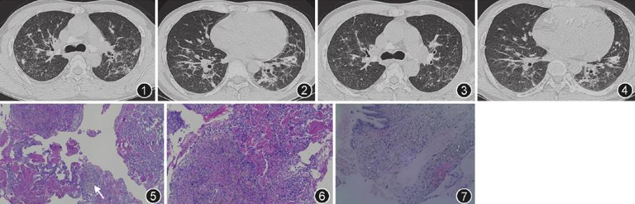 急性纤维性机化性肺炎病因,重症支气管肺炎的疑难病例讨论