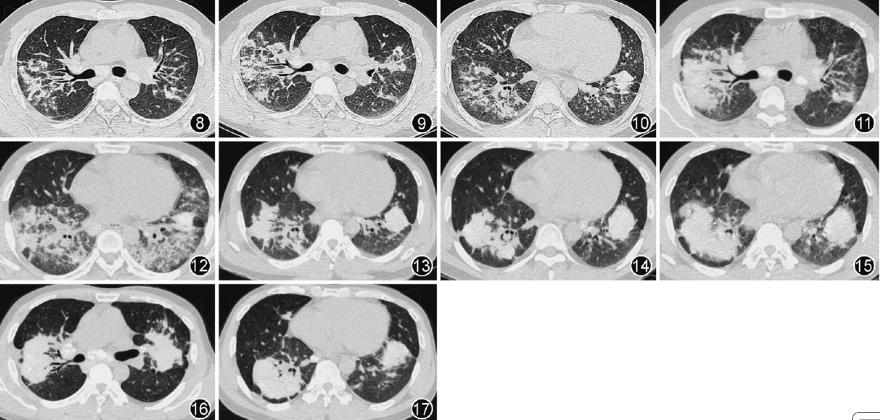 急性纤维性机化性肺炎病因,重症支气管肺炎的疑难病例讨论