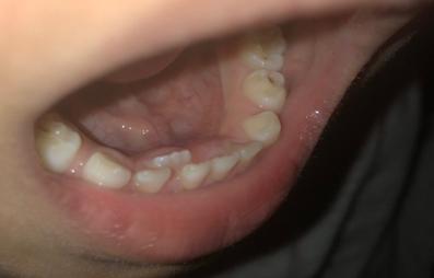 换牙出现双排牙不齐怎么办,孩子换牙齿长双排牙怎么办