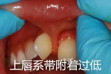 换牙出现双排牙不齐怎么办,孩子换牙齿长双排牙怎么办