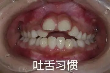 换牙出现双排牙不齐怎么办,孩子换牙齿长双排牙怎么办