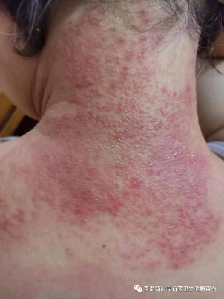 春季湿疹反复发作怎么治疗,湿疹反复痒怎么办