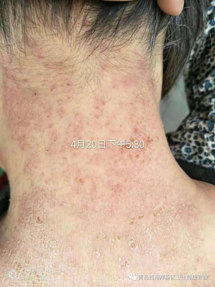 春季湿疹反复发作怎么治疗,湿疹反复痒怎么办