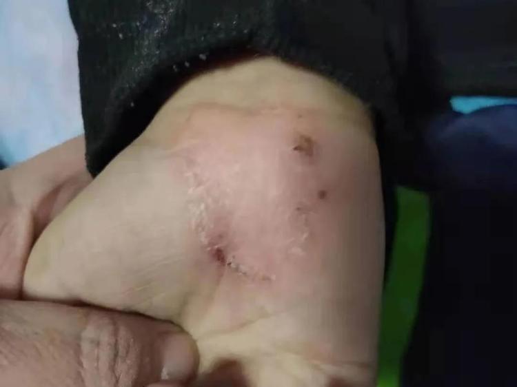 春季湿疹反复发作怎么治疗,湿疹反复痒怎么办