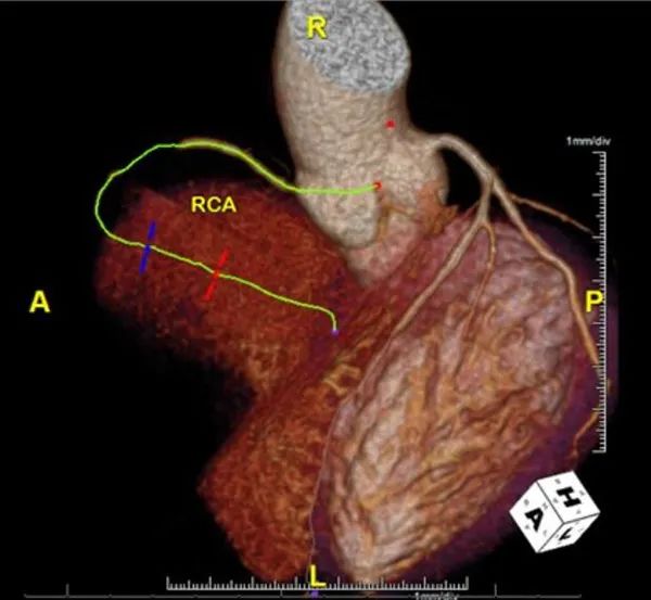 血糖30多也没发生酮症酸中毒,血糖高胸痛是什么病变