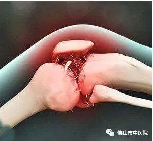 关节异响可以自愈嘛,关节咔咔响一招解决小妙招