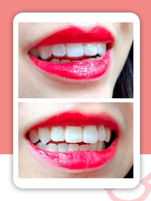 牙齿缝隙大隐形牙套矫正前后对比,牙齿前突隐形牙套矫正的全过程