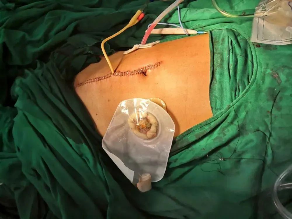 男子钢筋穿身体,男子身体插进5根钢筋救活了吗