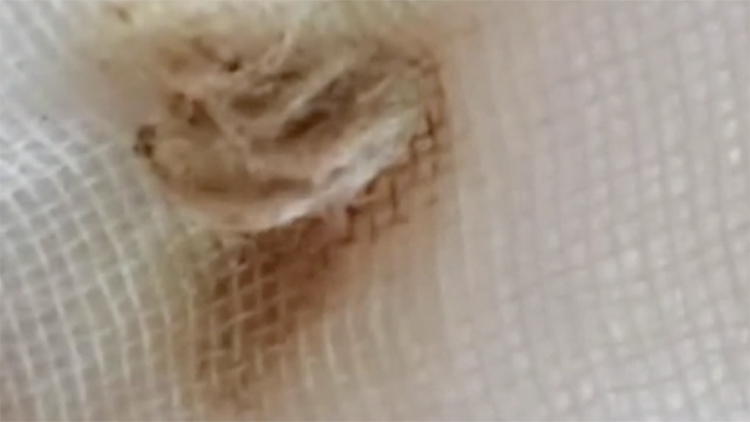 2岁女童医院检查早熟,2岁女童体下有臭味怎么回事