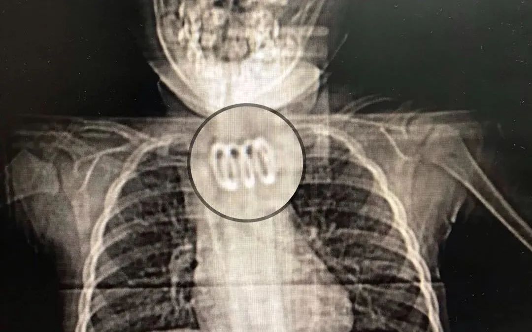 孩子反复呕吐喝水都吐咳嗽,引起一岁宝宝干呕的原因