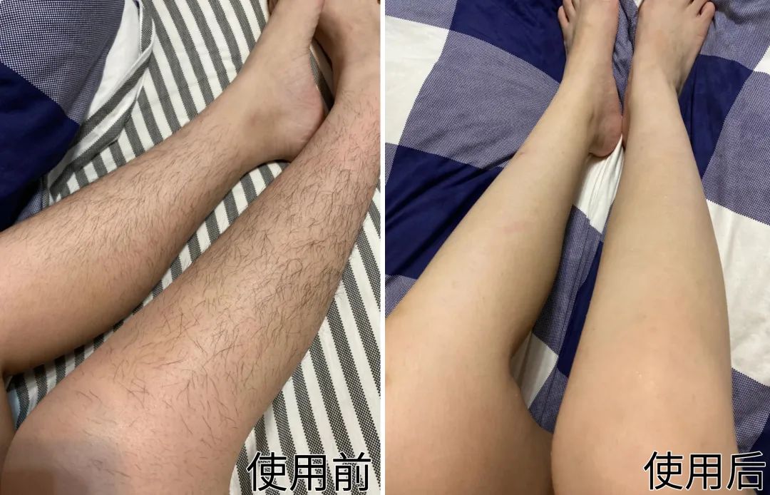 夏季脱毛必备,夏日必备脱毛告别尴尬