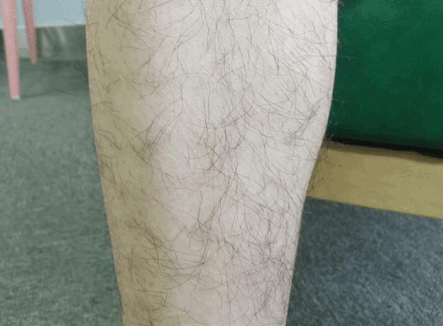 夏季脱毛必备,夏日必备脱毛告别尴尬