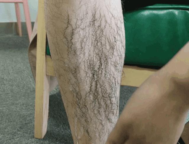 夏季脱毛必备,夏日必备脱毛告别尴尬