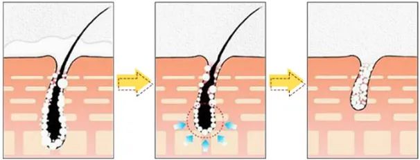 夏季脱毛必备,夏日必备脱毛告别尴尬