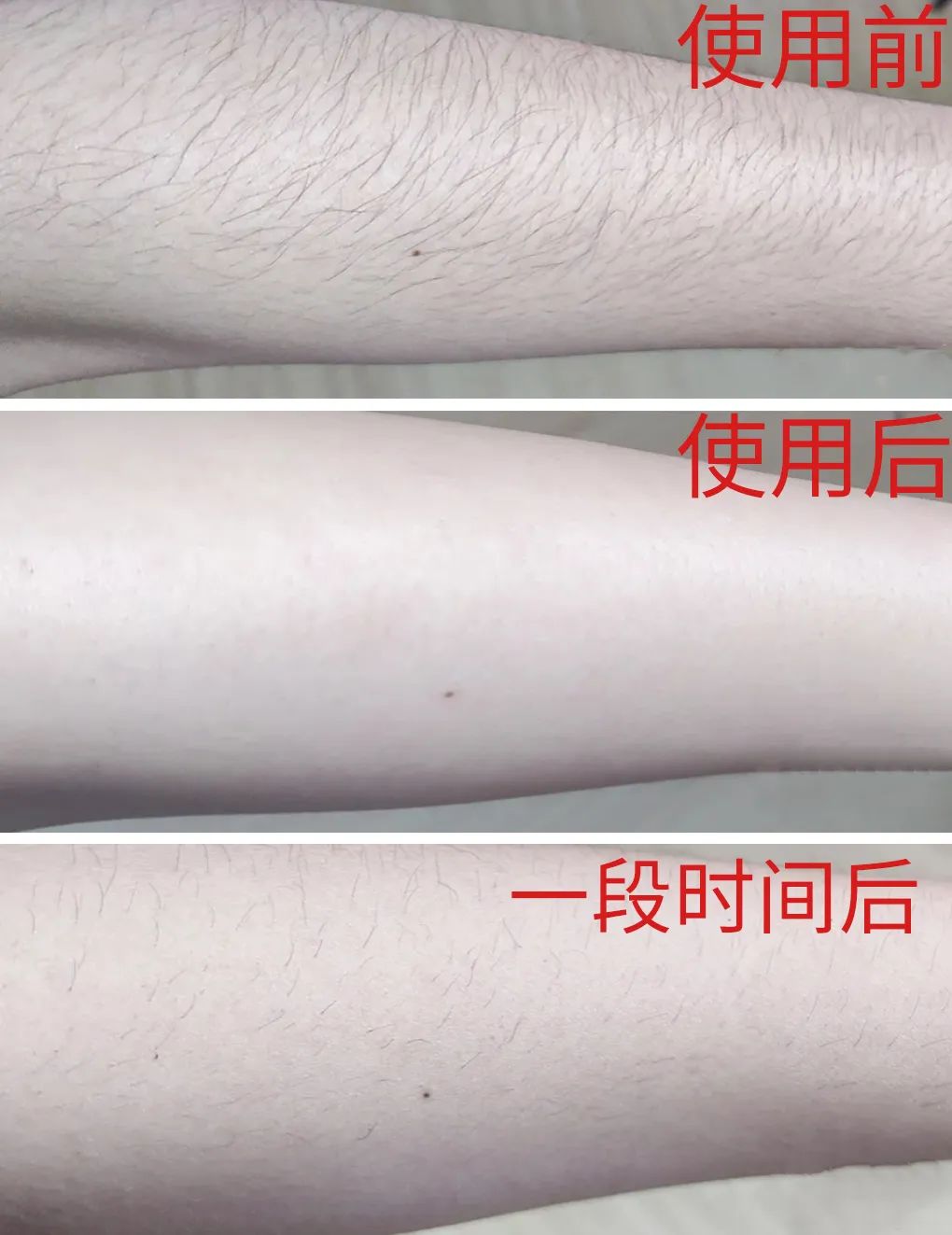 夏季脱毛必备,夏日必备脱毛告别尴尬