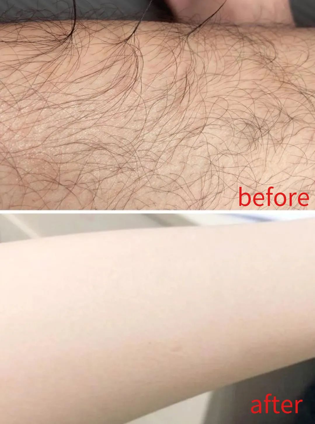 夏季脱毛必备,夏日必备脱毛告别尴尬