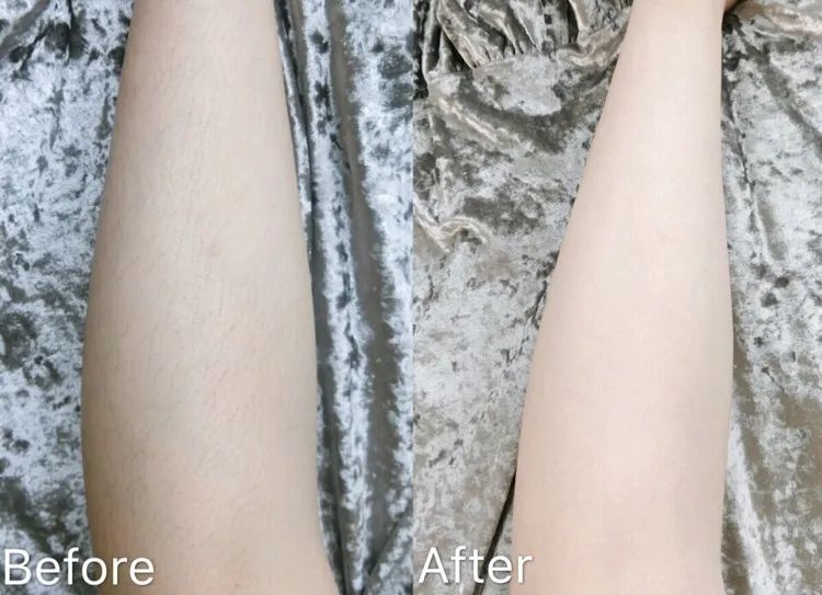 夏季脱毛必备,夏日必备脱毛告别尴尬