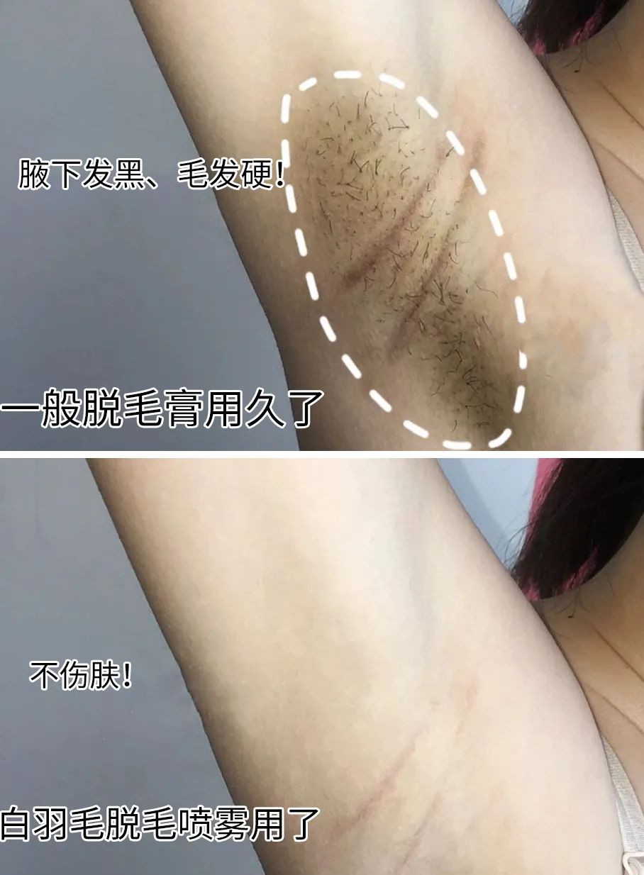 夏季脱毛必备,夏日必备脱毛告别尴尬