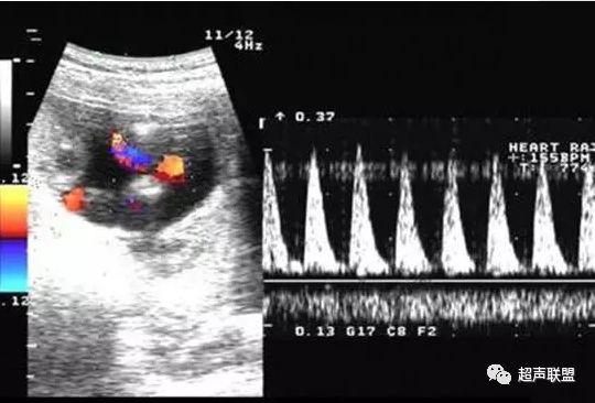 胎儿宫内窘迫如何判断,38周如何判断胎儿宫内窘迫或缺氧