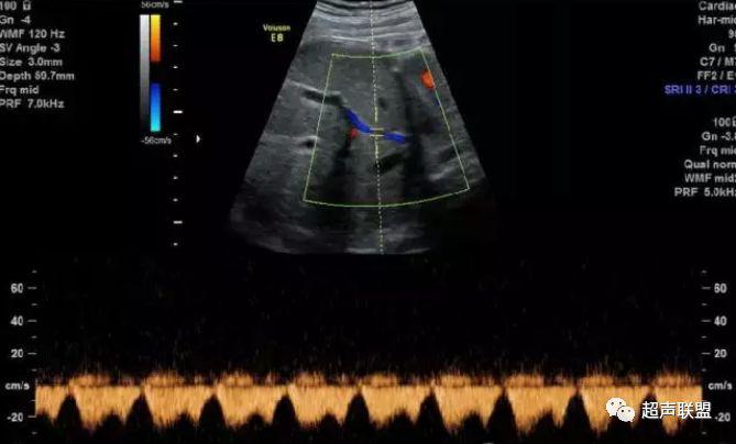 胎儿宫内窘迫如何判断,38周如何判断胎儿宫内窘迫或缺氧