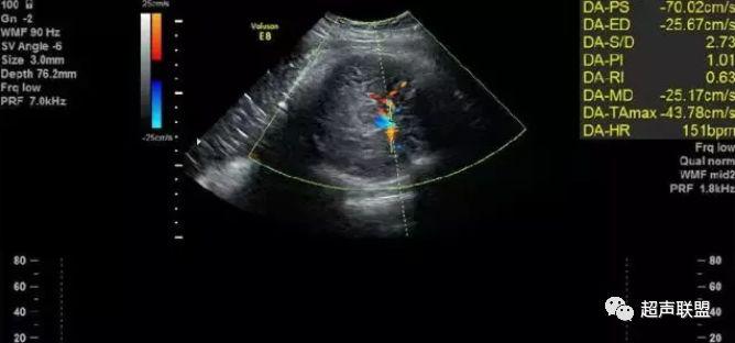 胎儿宫内窘迫如何判断,38周如何判断胎儿宫内窘迫或缺氧