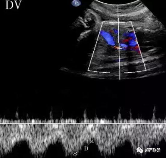 胎儿宫内窘迫如何判断,38周如何判断胎儿宫内窘迫或缺氧