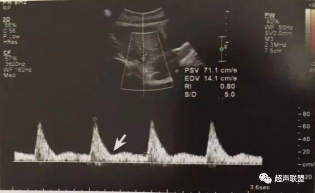 胎儿宫内窘迫如何判断,38周如何判断胎儿宫内窘迫或缺氧