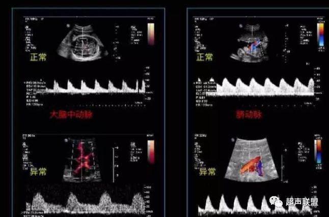 胎儿宫内窘迫如何判断,38周如何判断胎儿宫内窘迫或缺氧