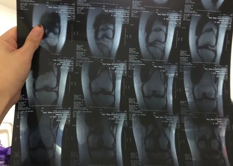 因为跳健身操,我韧带断了,花了4w做手术