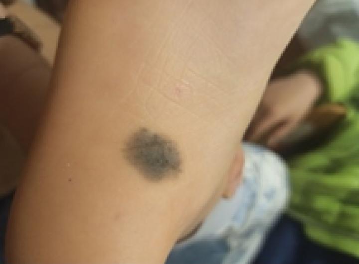 黑痣癌变的痣会很大吗,黑痣癌变一般是一个痣还是好多