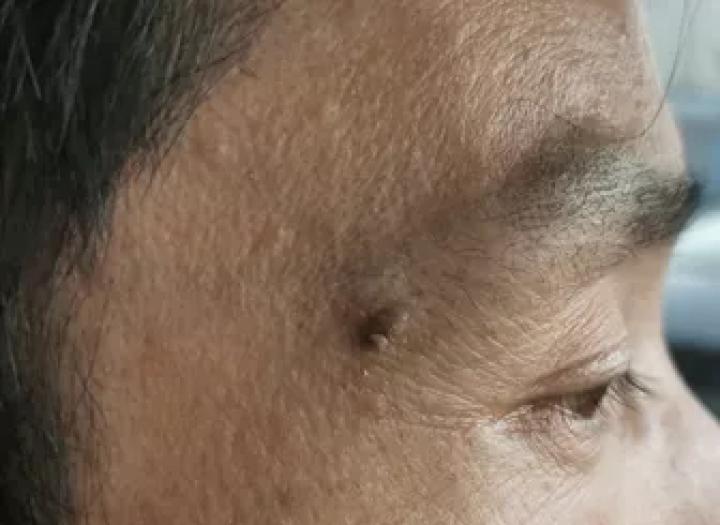 黑痣癌变的痣会很大吗,黑痣癌变一般是一个痣还是好多