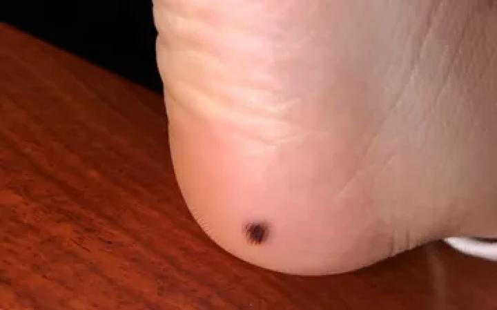 黑痣癌变的痣会很大吗,黑痣癌变一般是一个痣还是好多