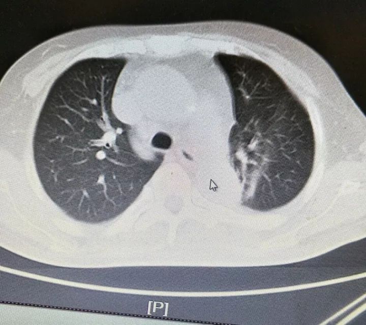 肌钙蛋白一直在持续升高,肌钙蛋白突然偏高的原因