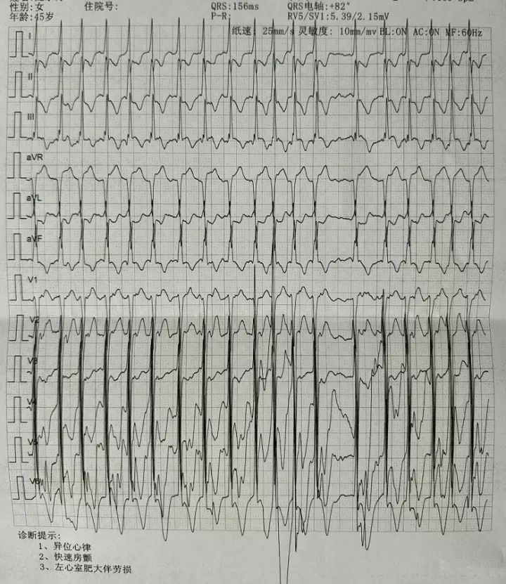 肌钙蛋白一直在持续升高,肌钙蛋白突然偏高的原因