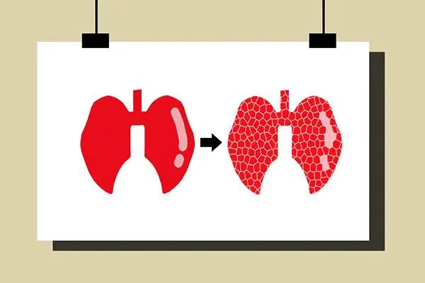 咳嗽咳出黄痰是什么信号,白痰绿痰黄痰都代表什么样的病情