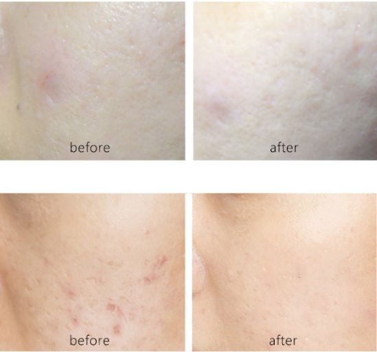 干皮痘肌护肤全过程,干皮痘肌精简护肤步骤